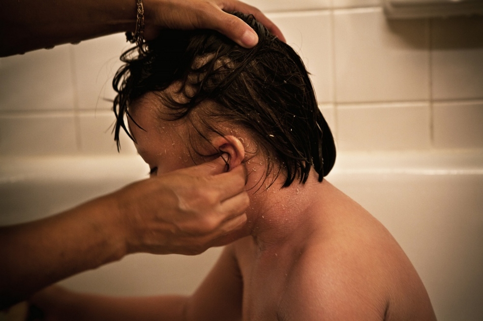 孤兒?。呼~(yú)鱗病女孩的艱難生活【圖】