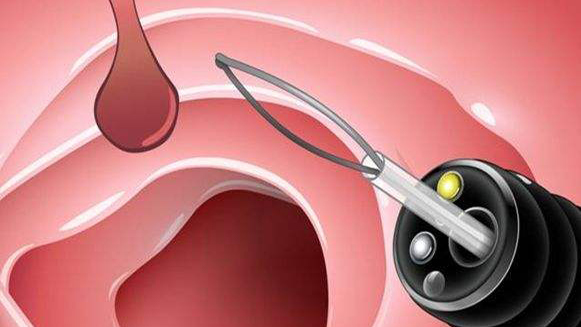 【健康解碼&middot;小貼士】檢查出息肉 需要切除嗎？